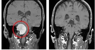 Petroclival Meningioma Surgery Ahmedabad